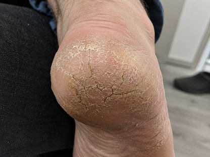 HeelJoy Pro | Dites Adieu Aux Talons Fissurés